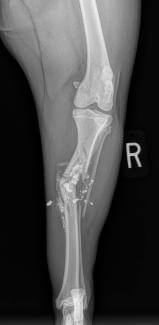 comminuted tibial fracture gun shot straight