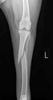 Tib FIb Fracture alternate view
