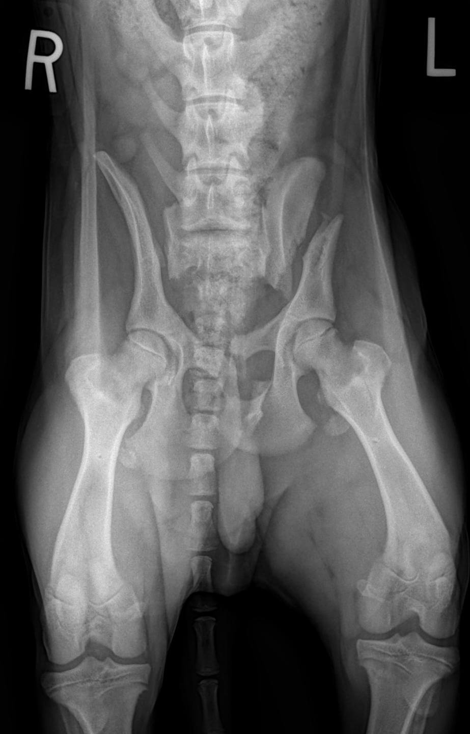 pelvic fracture sacroiliac SI luxation ilial body fracture