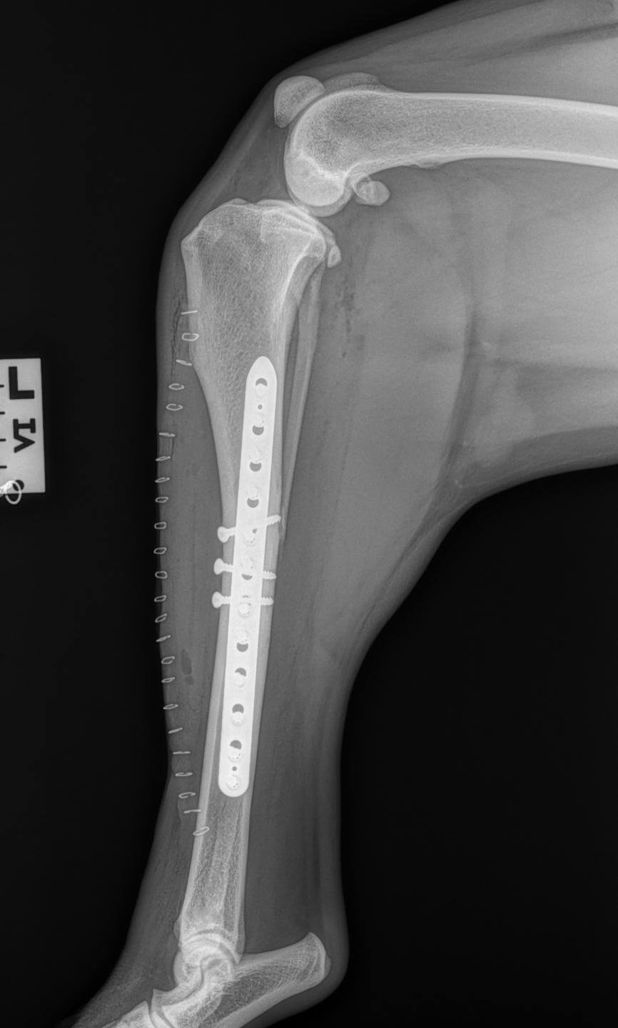 butterfly fracture tibia plate