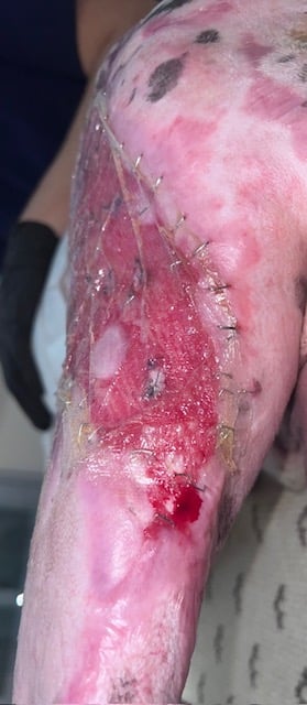 3 days after fish skin grafting and applying spray on skin cells and creating punch grafts