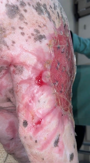3 days after fish skin grafting and applying spray on skin cells and creating punch grafts