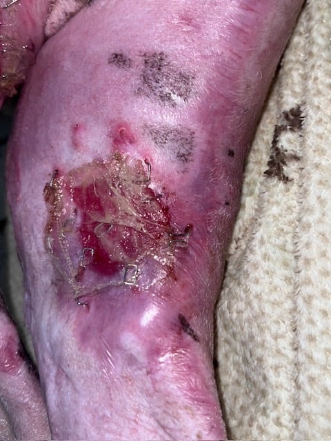 3 days after fish skin grafting and applying spray on skin cells and creating punch grafts