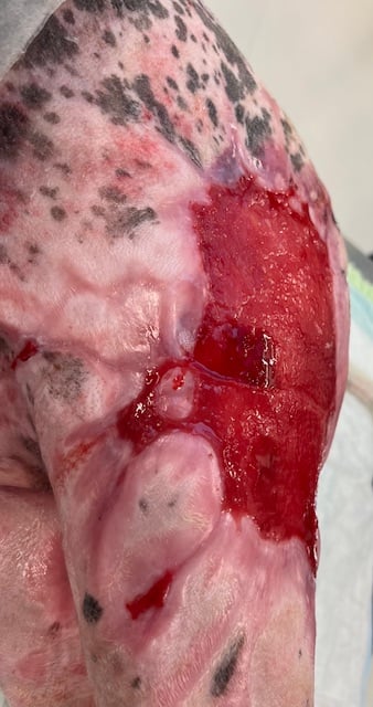 Day 56 Dog burn wounds before 3rd round of grafting