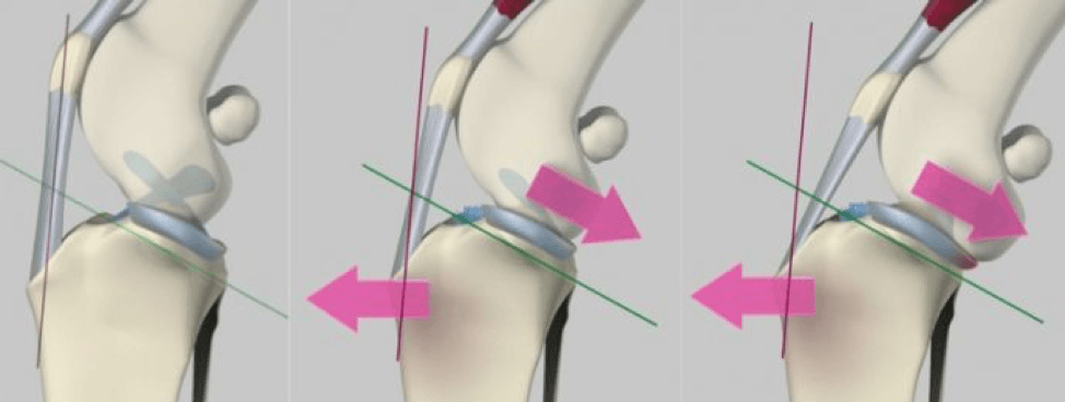 Mechanics of cruciate ligament disease