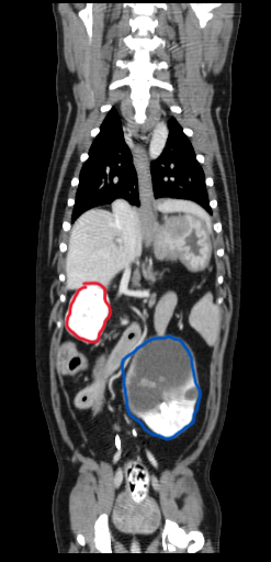 Normal and abnormal kidneys with markers