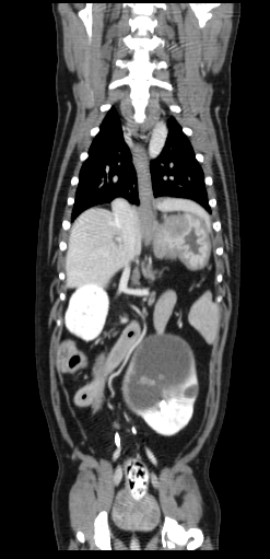 Normal and abnormal kidneys