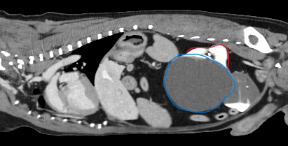 Cyst on Left Kidney (marked with blue line)