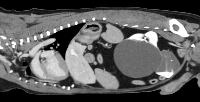 Cystic Left Kidney