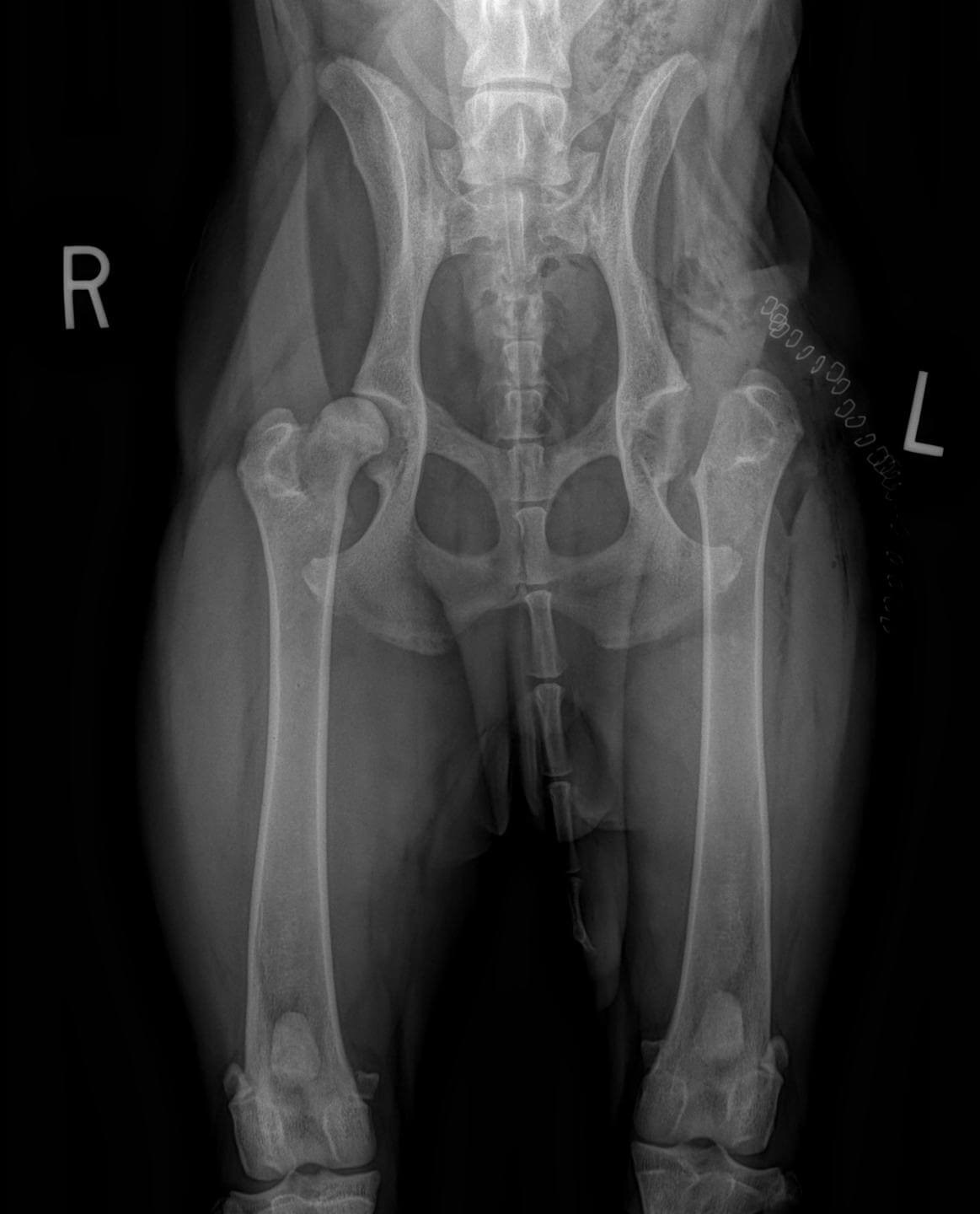 femoral head and neck excision FHNE