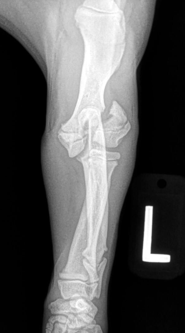 Fracture of the latearl condyle of the humerus