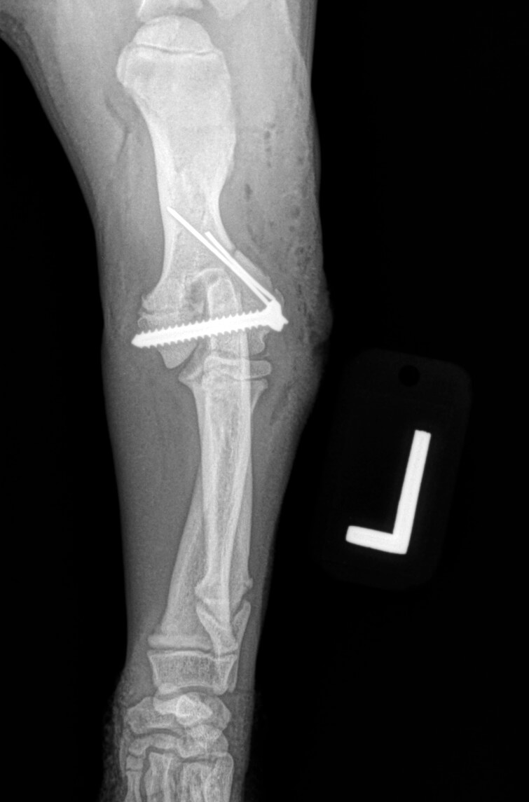 repaired lateral condyle fracture of the humerus