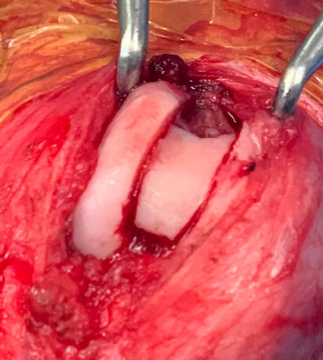 Medial patella Luxation (MPL)  Recession Sulcoplasty step 1