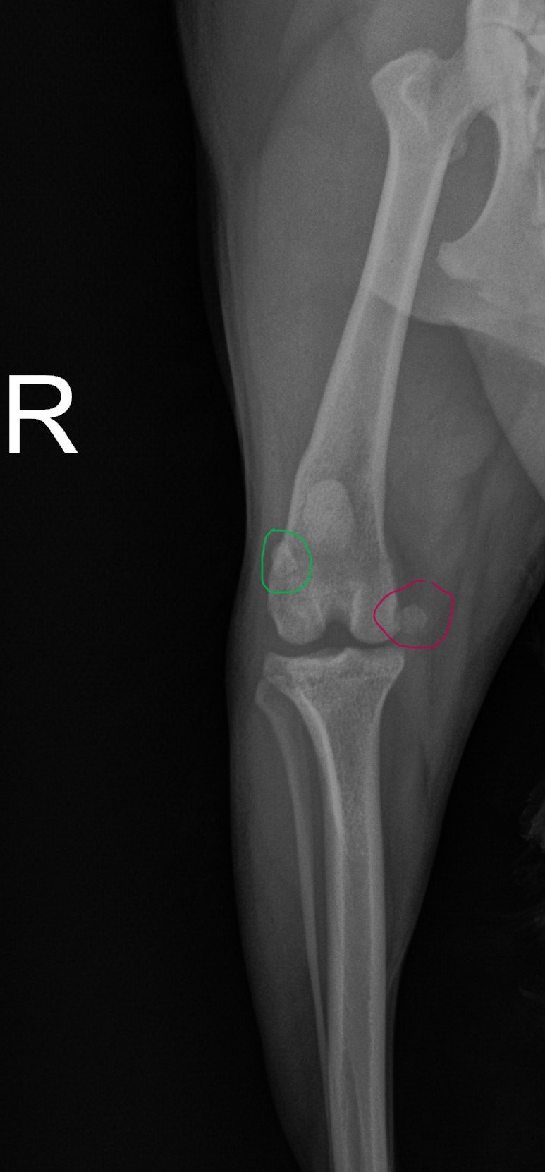 Avulsion of the medial head of the gastrocnemius