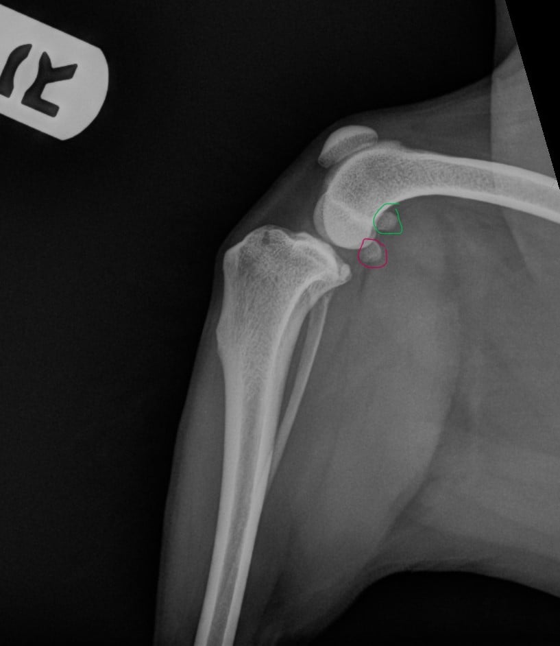 avulsion of the medial head of the gastrocnemius in the dog