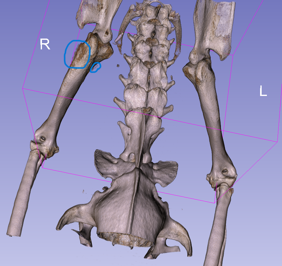 osteosarcoma of the proximal humerus