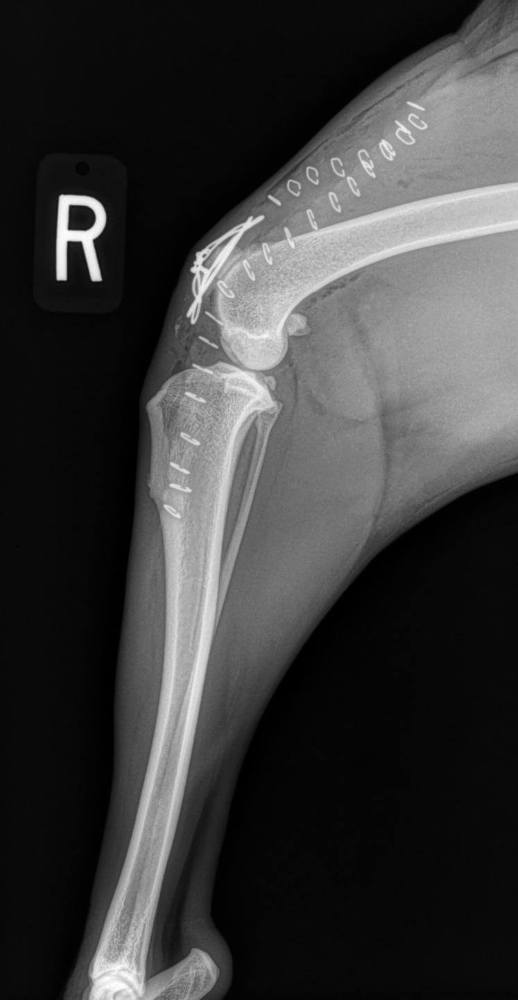 Repaired fracture of the patella