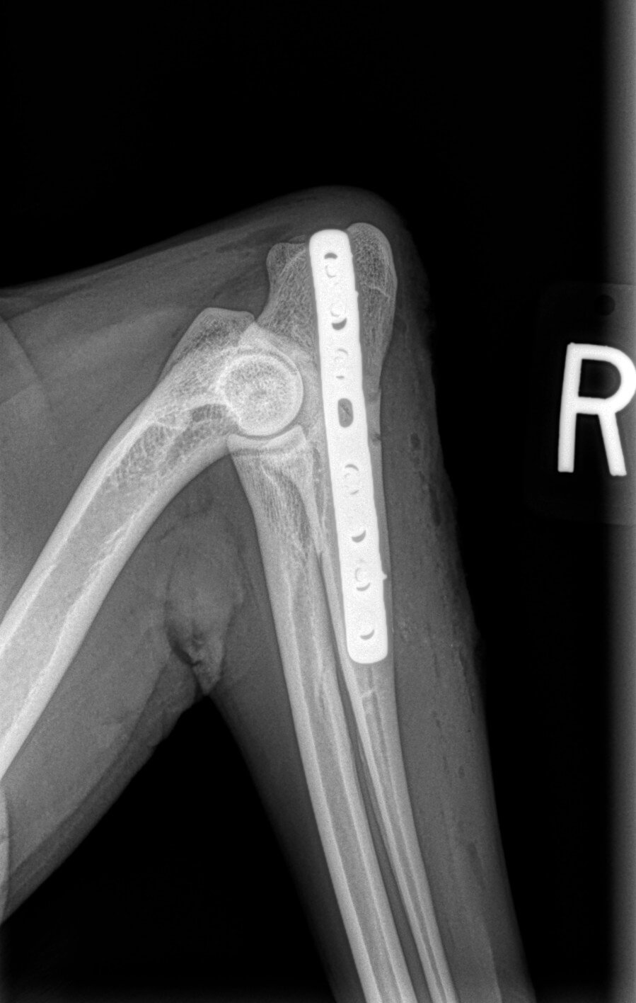 ulnar articular fracture