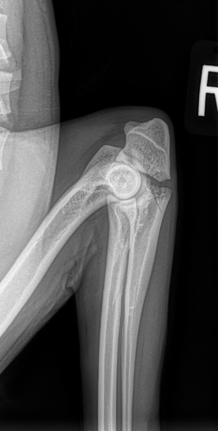 ulnar articular fracture