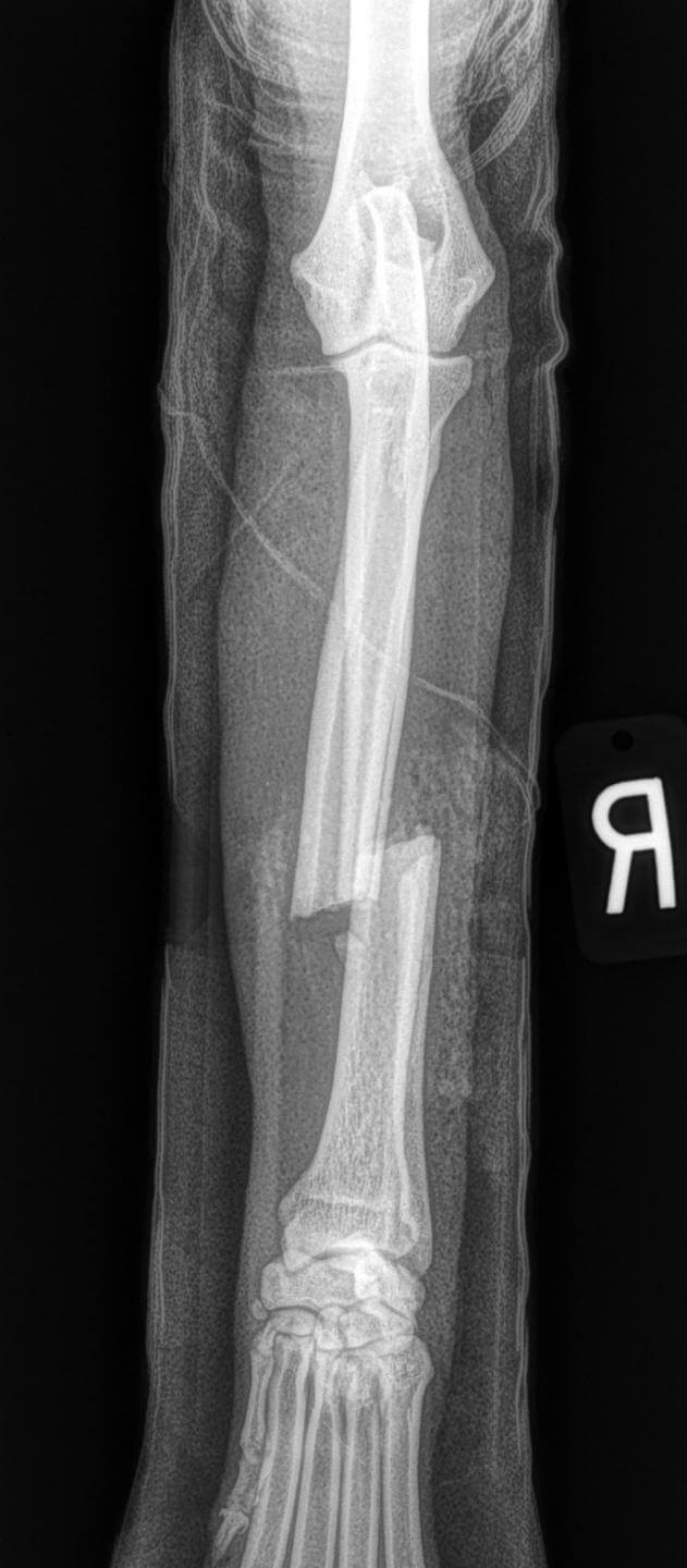 Canine fracture radius ulnar mid diaphyseal