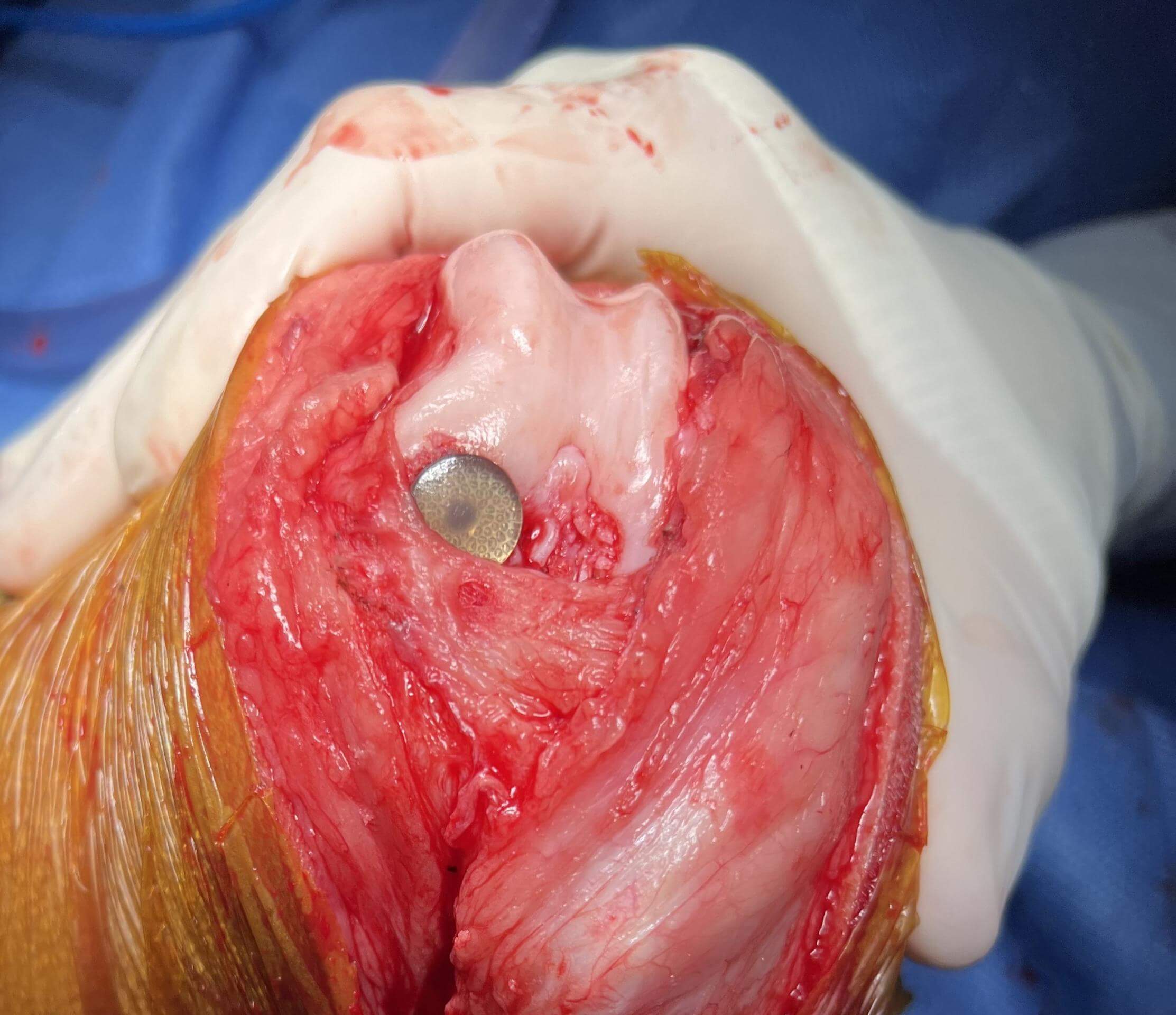 Canine OCD Stifle Lesion repaired with Synacart