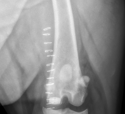 Synacart cartilage implant on the femoral condyle