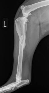Butterfly fracture tibia