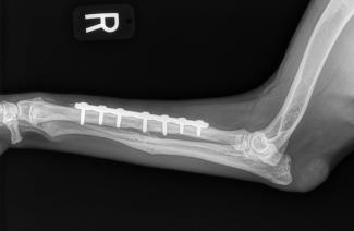 fractured radius and ulnar, radial plate, ulnar pin removed