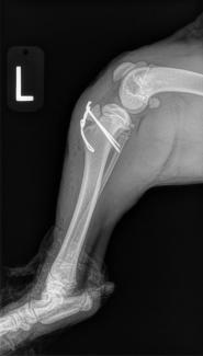 tibial tuberosity avulsion fracture pin and tension band