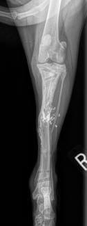 comminuted tibia fracture healed