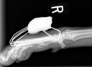 spider frame metacarpal fracture repair