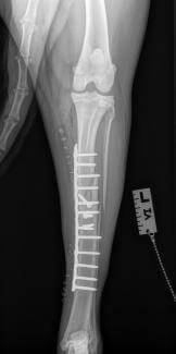Tib FIb Fracture with screws