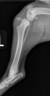 tibial tuberosity avulsion fracture